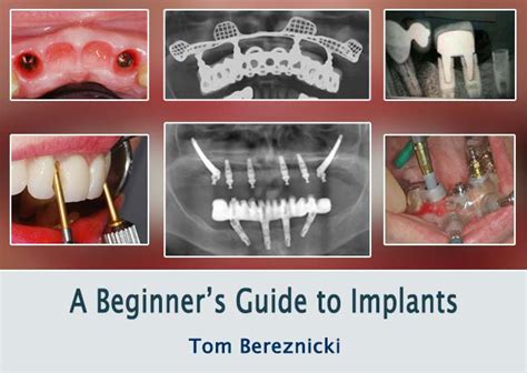 We did not find results for: The Dental Channel - A Beginner's Guide to Implants