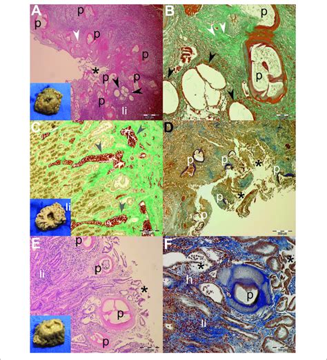 Gross Pathological Insets And Histopathological Findings Of Gastric