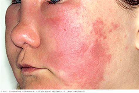 Symptoms And Causes Hives And Angioedema Mayo Clinic