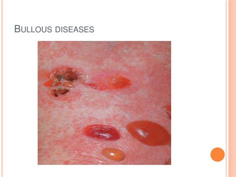 Ppt Bullous Diseases Powerpoint Presentation Id806425