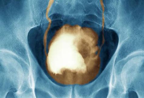 There are a number of symptoms that might indicate bladder cancer like fatigue, weight loss, and bone tenderness, and these can indicate more advanced disease. Blasenkrebs Symptome, Stadien, Behandlung - 2020