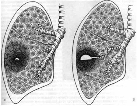 Симптоматика и методы лечения абсцесса легких – Медицинский портал Картинка - Симптоматика и методы лечения абсцесса легких – Медицинский портал