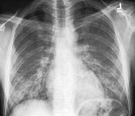 Image Pneumocystis Pneumonia Msd Manual Professional Edition