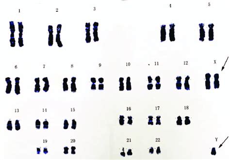 Chromosome 47 Xxy Syndrome Syndrome De Klinefelter Filmisfine