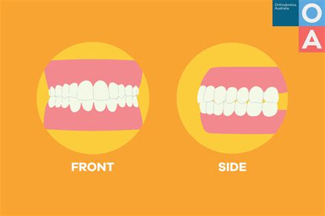 Orthodontics Australia How Should Teeth Rest