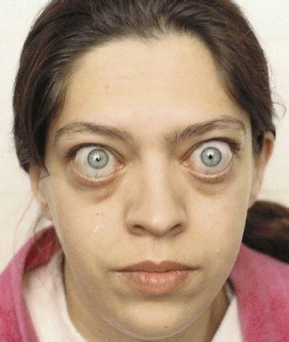 Iodium-Exophthalmus | PICTURE MATERIA MEDICA