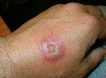 Your doctor will ask what your main symptoms are, when they began. Black Widow Spider Bite Pictures, Facts, Brown, Symptoms ...