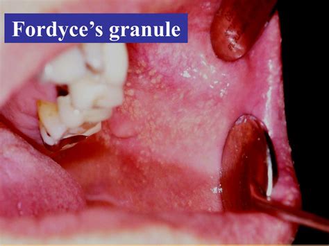 Fordyce Granules On Buccal Mucosa