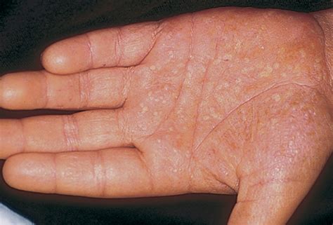 What To Know About Palmoplantar Pustulosis The Dermatology Center Of