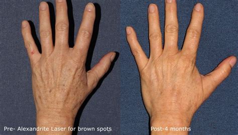 Hand Rejuvenation San Diego Ca Cosmetic Laser Dermatology