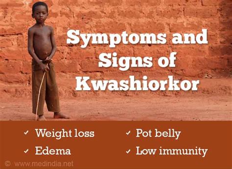 Signs And Symptoms Of Kwashiorkor