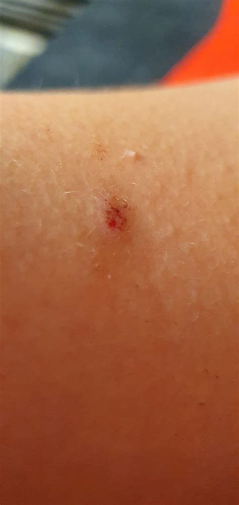 This Thing Appeared On My Arm A Week Ago Should I Be Worried Rmelanoma