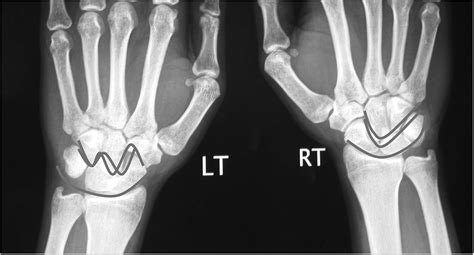 Chronic Trans Scaphoid Perilunate Dislocation Current Management Protocol Journal Of Clinical
