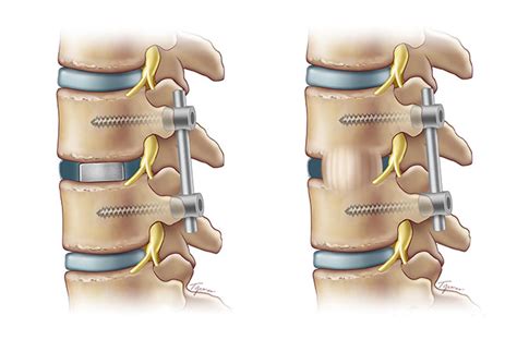 Minimally Invasive Spinal Fusion Doctorvisit