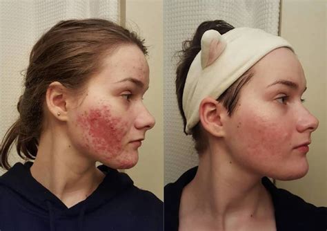 Acne After Accutane Related Stories