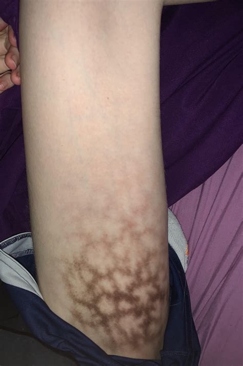 Pattern On Inner Thighs Are That Is There Should I Be Worried R
