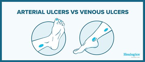 Arterial Vs Venous Ulcers What Are The Differences