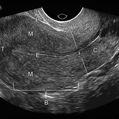 transvaginal doppler ultrasound of the uterus shows my xxx hot girl