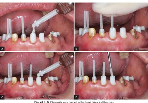 Figure 1 From Pre Endodontic Post And Core Technique For Endodontic And