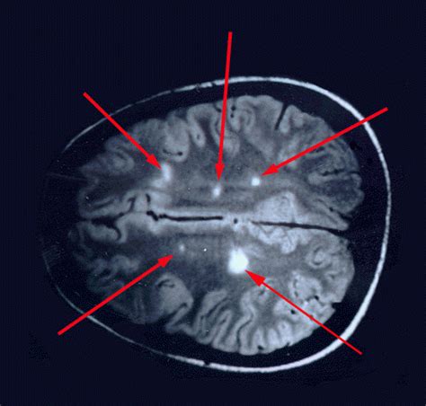 Maybe you would like to learn more about one of these? DIAGNÓSTICO DE ESCLEROSIS MÚLTIP