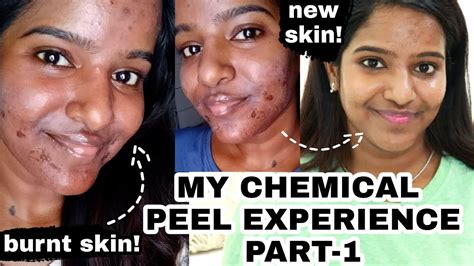 My Chemical Peel Experiencesession1 Before And After Skin Update