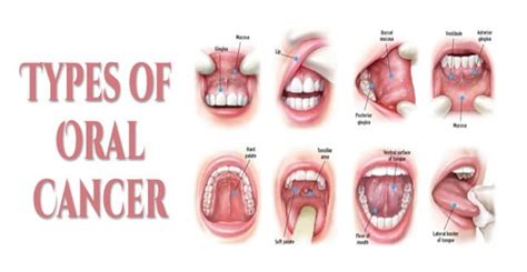 Oral Cancer Symptoms Causes And Risk Factors