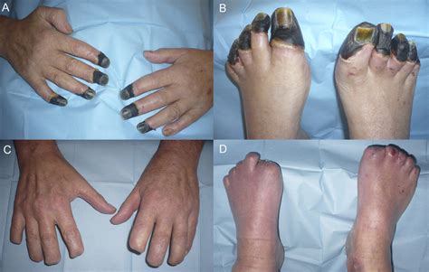 A And B Severe Dry Necrosis Extending To Both Hands And Feet C And Download Scientific