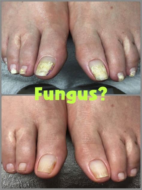 How To Treat White Spots On Toenails Tutor Suhu