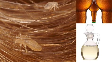 How To Get Rid Of Lice Fast At Home With This Simple Safe And Natural