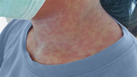 Rubella German Measles Symptoms Treatment During Pregnancy