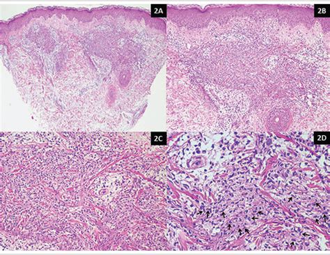 Scielo Brasil Metastatic Cutaneous Crohns Disease As An Important