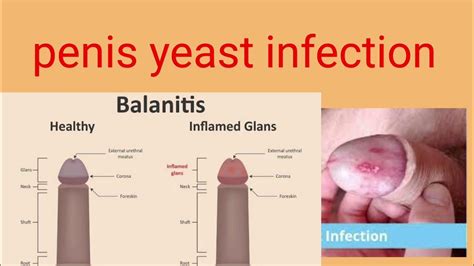 Yeast Infection Should You Be Worrying Penis Yeast Youtube