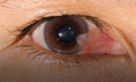Pterygium Causes Symptoms Diagnosis Treatment Pterygium Eye Surgery