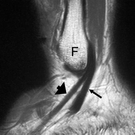Normal Variants And Diseases Of The Peroneal Tendons And Superior