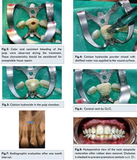 For all five pulpotomy steps, the anesthesia effectiveness. CVEK PULPOTOMY PDF