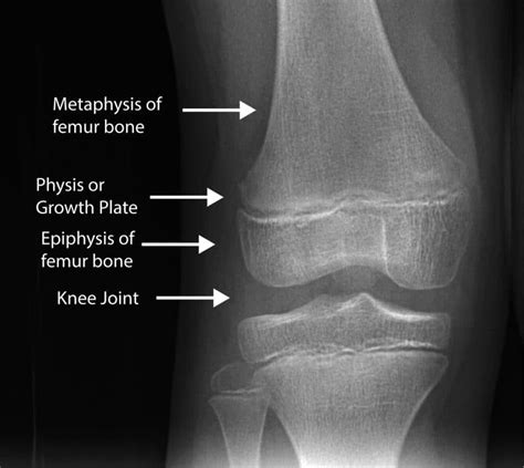 Growth at the epiphyseal plate: Can Weightlifting Stunt Growth in Kids and Teens? - Grow Taller Naturally