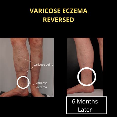 Can Varicose Eczema Be Cured The Veincare Centre
