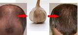 Best Medication For Hair Regrowth Images