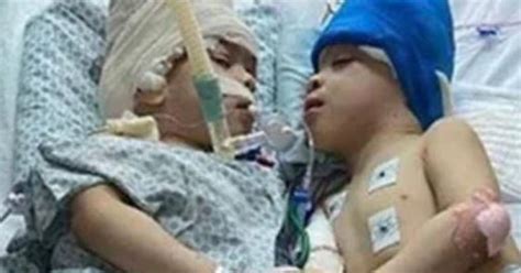 Vr Technology Helps To Separate Brazilian Conjoined Twins With Fused