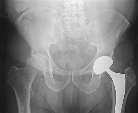 Total Hip Arthroplasty Stock Photos Pictures And Royalty Free Images