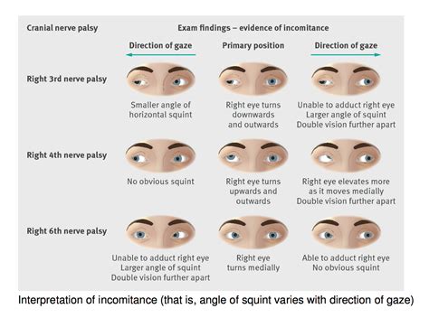 Cranial nerve palsy is a neurological disorder. Cranial Nerve Lesion - IM Reference