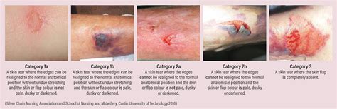 Figure 3 From Prevention And Management Of Skin Tears In Older People