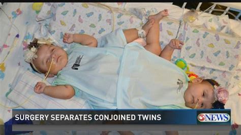 Conjoined Twins Separated In Successful Surgery