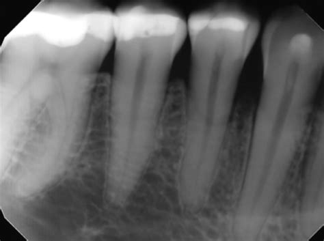 Intraoral Radiographic Anatomy Flashcards Quizlet