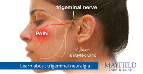Trigeminal Neuralgia Treatment