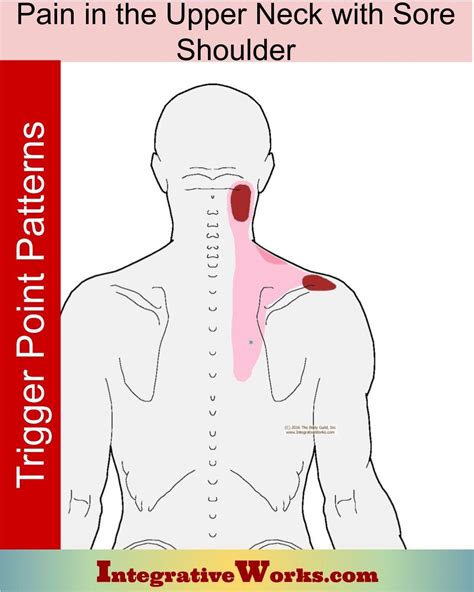 Upper Neck Pain With Sore Top Of Shoulder Integrative Works Sore