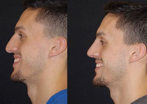 Crooked Nose Before And After 10 Rhinoplasty Cost