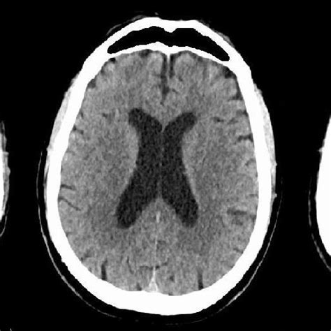 Ct Head Without Contrast Done At The Time Of Confusion Showed Normal