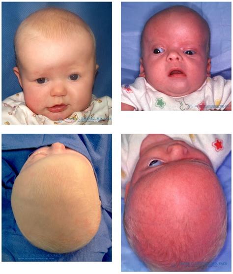 Plagiocephaly Refers To A Type Of Craniosynostosis In Which There Is