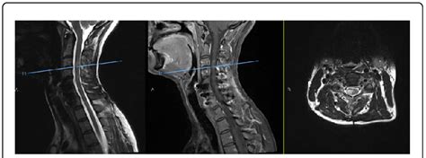 Left To Right Mri T2 Weighted Sagittal Of The Cervical Spine With